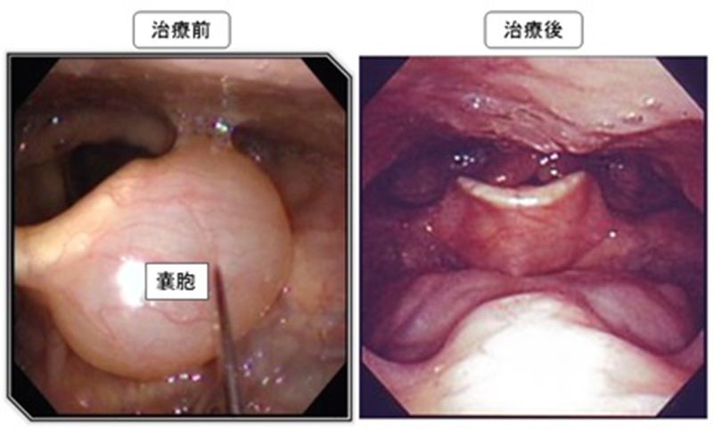 小児および成人の声帯結節