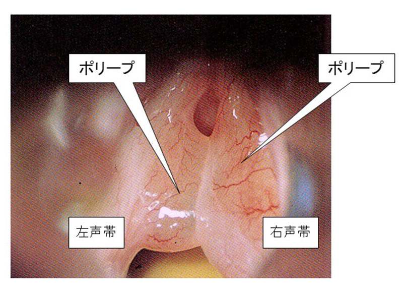 ポリープ様声帯
