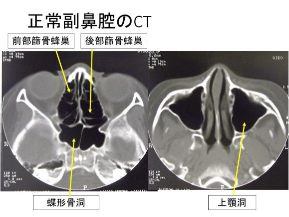 正常副鼻腔のCT