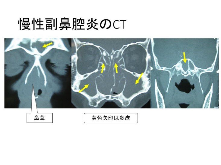 慢性副鼻腔炎のCT