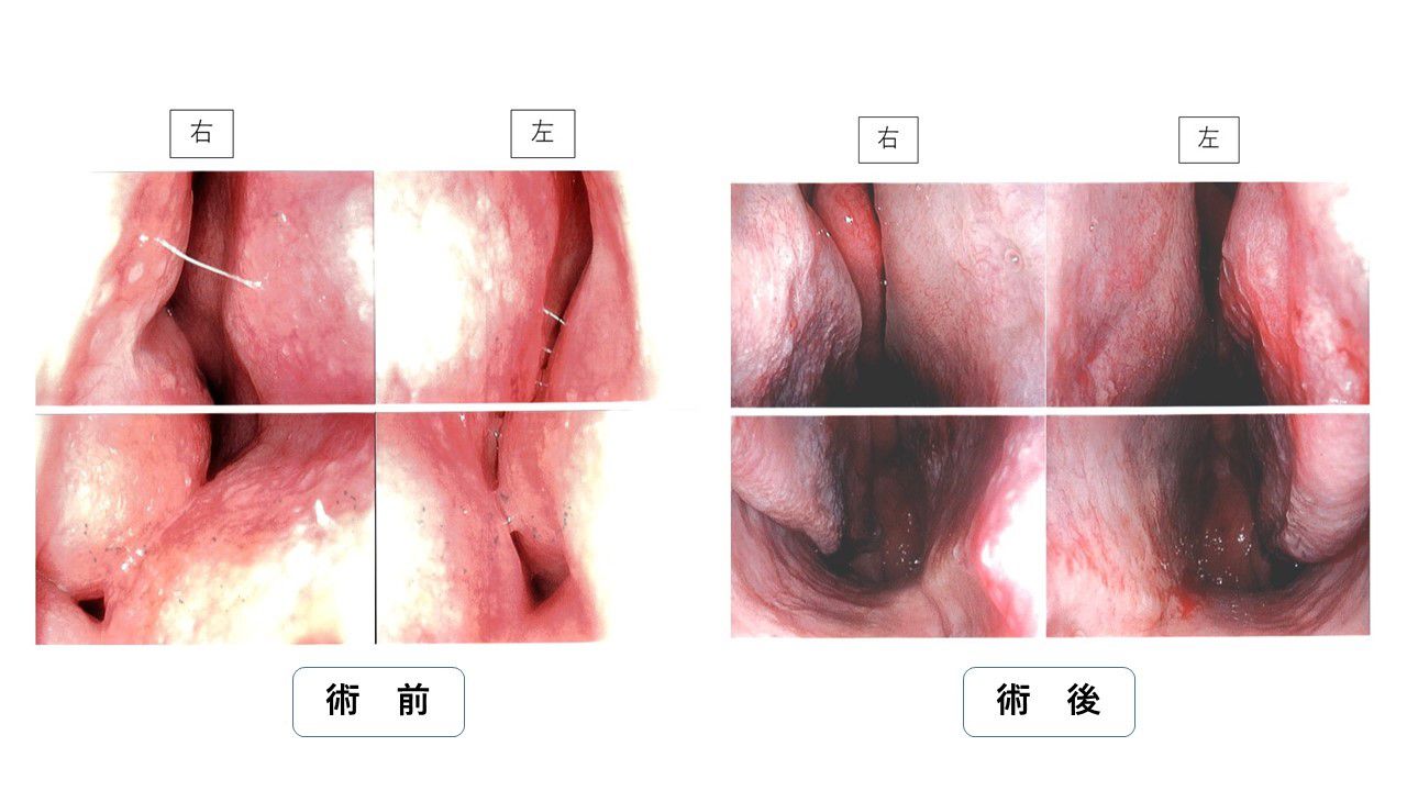 鼻中隔彎曲症の術前、術後