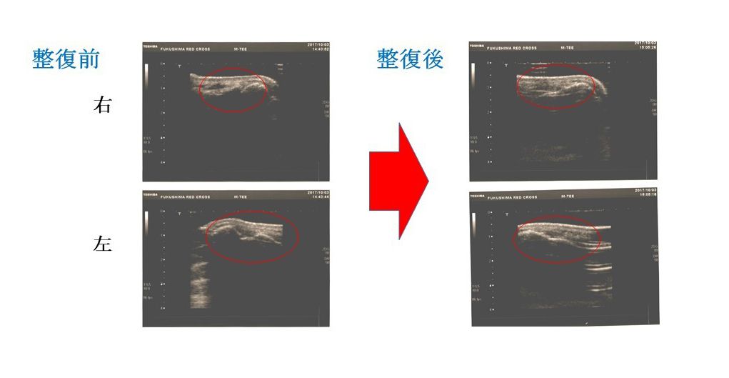 慢性副鼻腔炎のCT