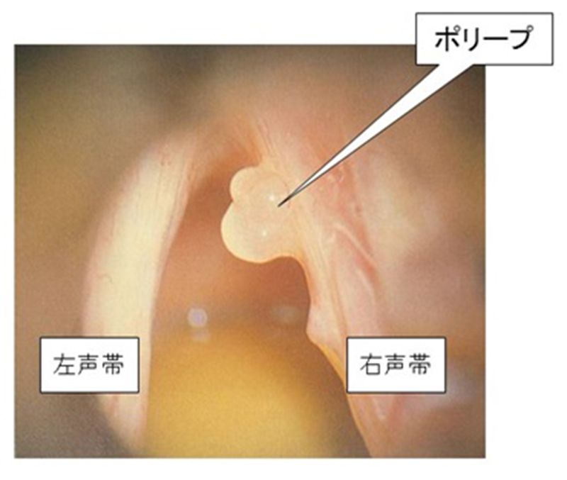 嚥下造影検査