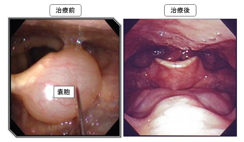 喉頭蓋嚢胞
