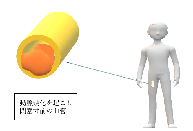 動脈硬化を起こし閉塞寸前の血管